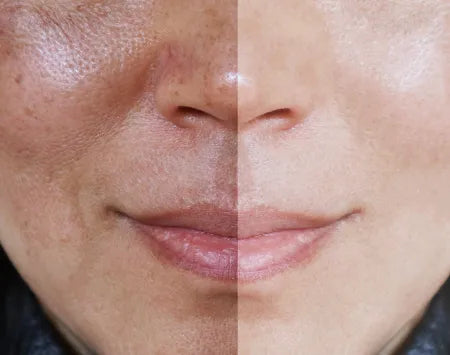 Crema Aclarante | ✨ Aclara tu Piel ✨ Resultados en una Semana!